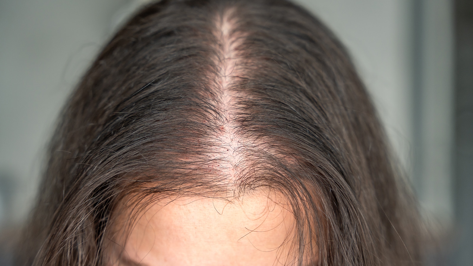 Close up view or woman with hair loss