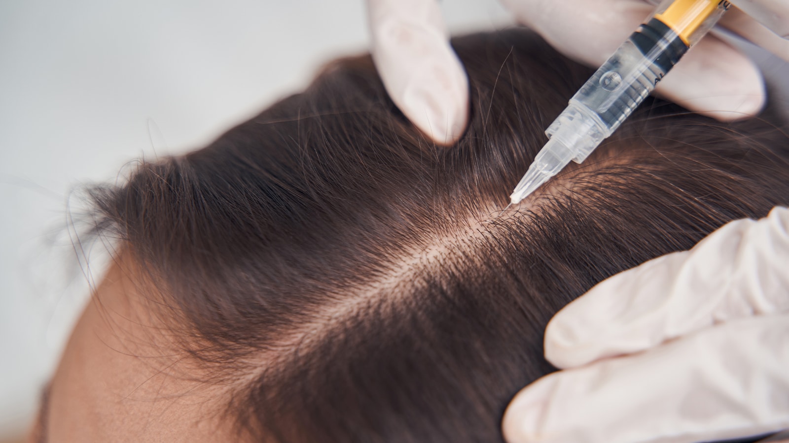 Hair treatment for hair loss