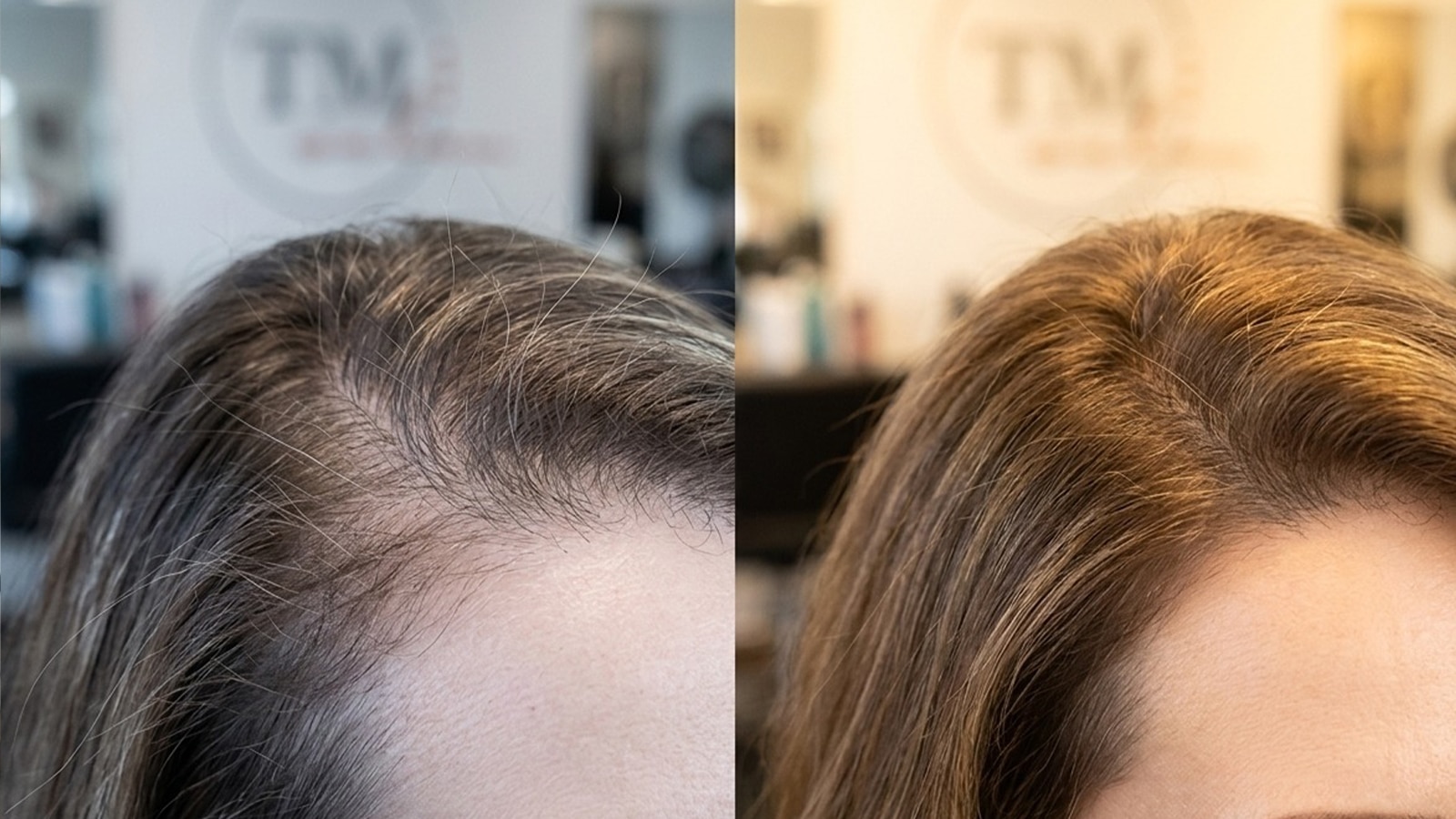 Woman with Postpartum hair loss before after